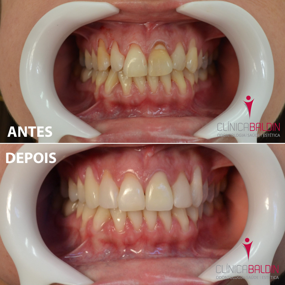 Tratamento com facetas e clareamento nos dentes anteriores superiores