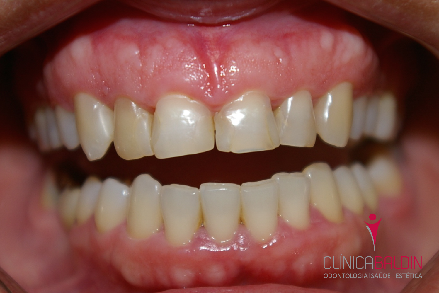 1A-Pac. com dentes anteriores muito restaurados e escurecidos