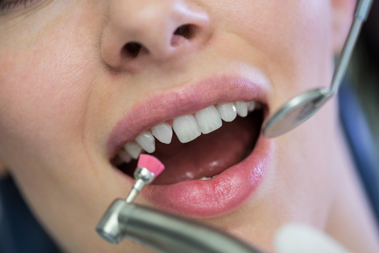 Tratamento de dentes conóides